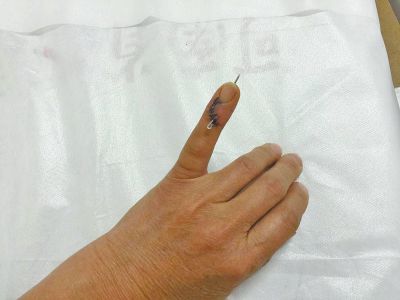 杨晚霞左小指骨折手术后留下两根固定针。